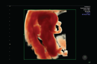 Ecografía Obstétrico 4D/5D