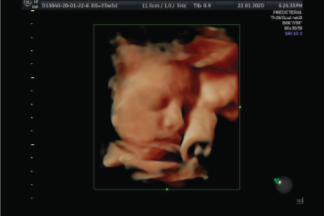 Ecografía Obstétrico 4D/5D