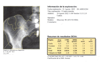Densitometría ósea