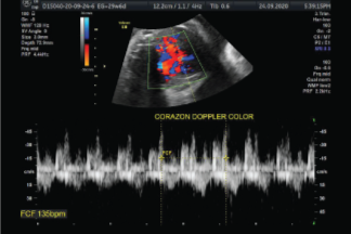 Ecografía Doppler Color