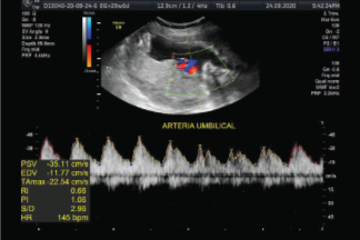 Ecografía Doppler Color