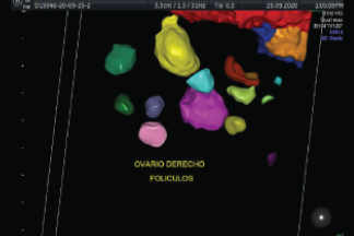 Seguimiento folicular