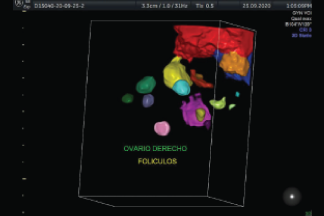Seguimiento folicular
