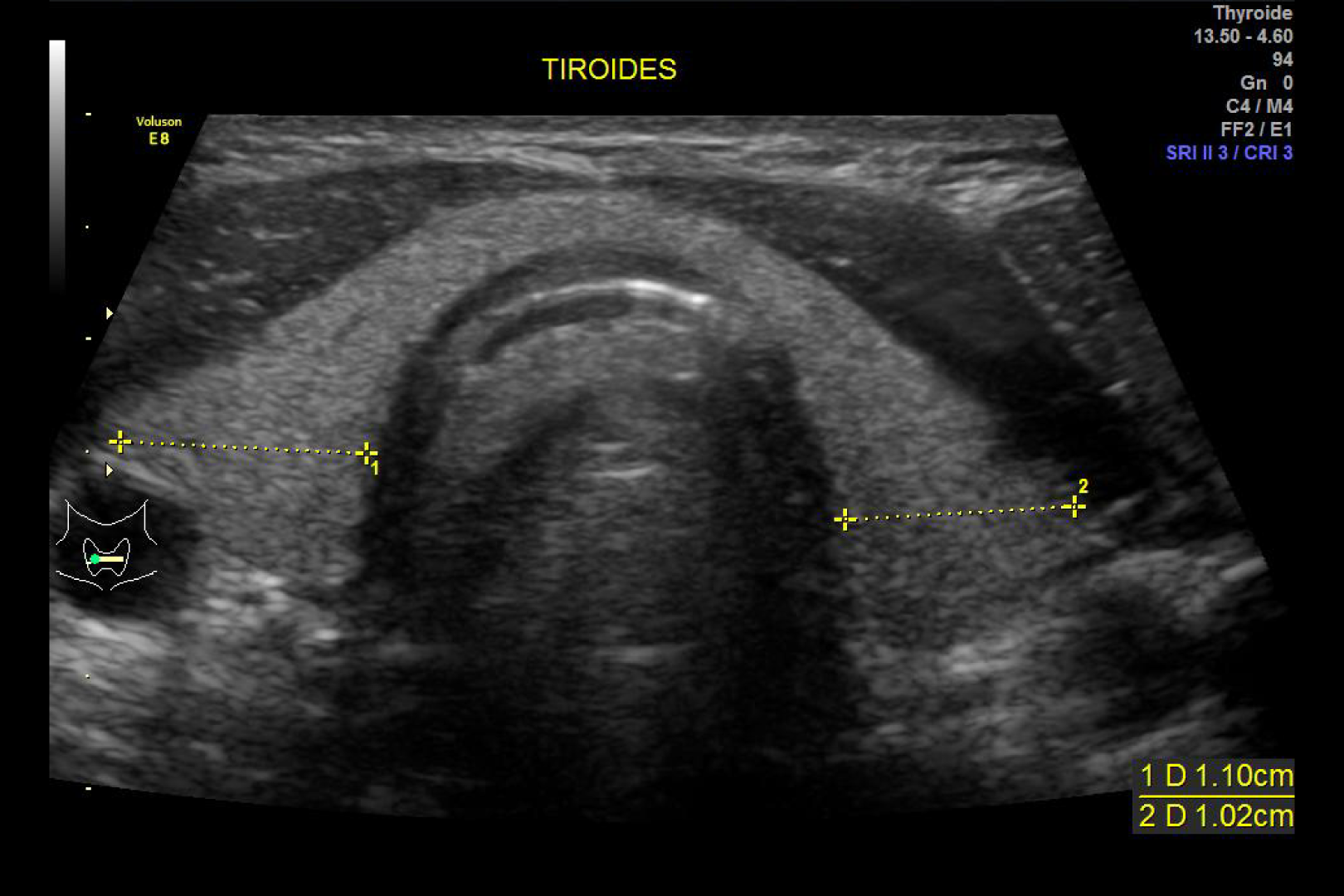 Biopsia de tiroides (Baff)