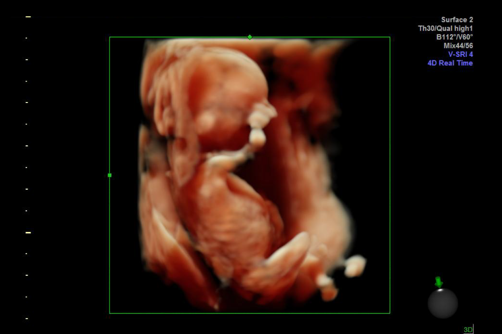 Ecografía Genético