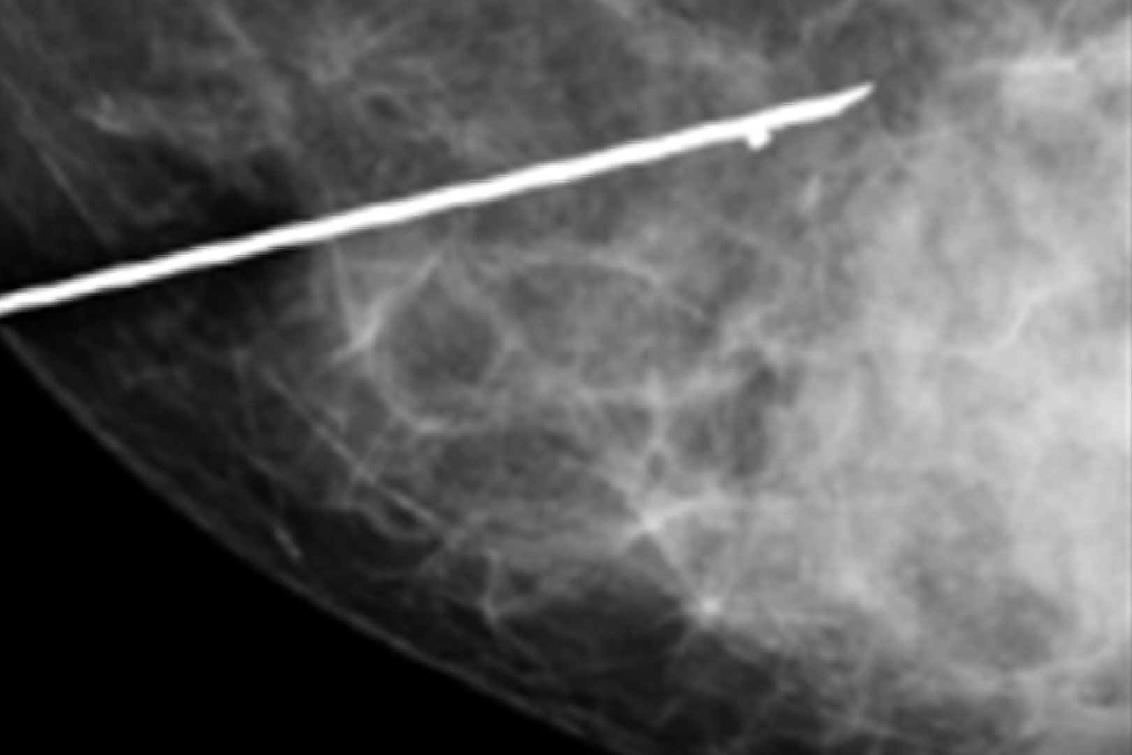 Marcaje prequirúrgico