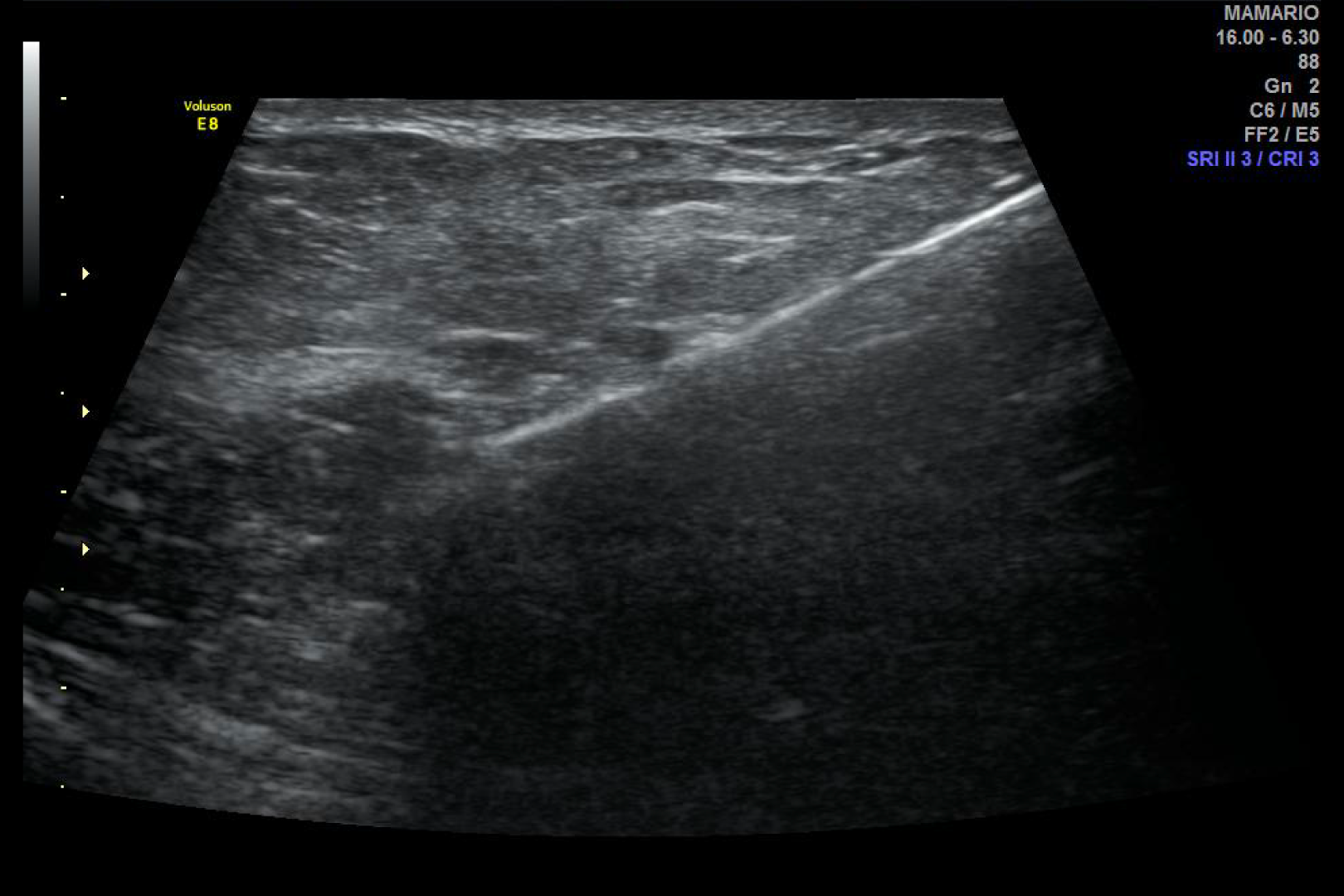 Biopsia guiada por ultrasonido