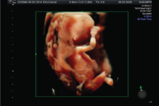 Ecografía Genética