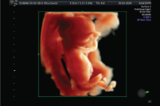 Ecografía Genética