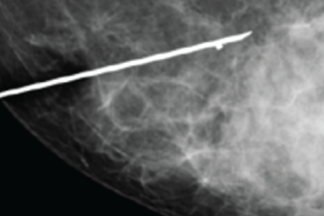 Marcaje prequirúrgico