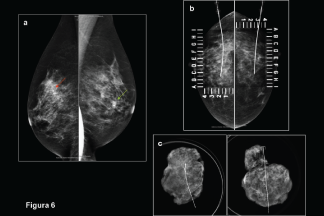 Marcaje prequirúrgico
