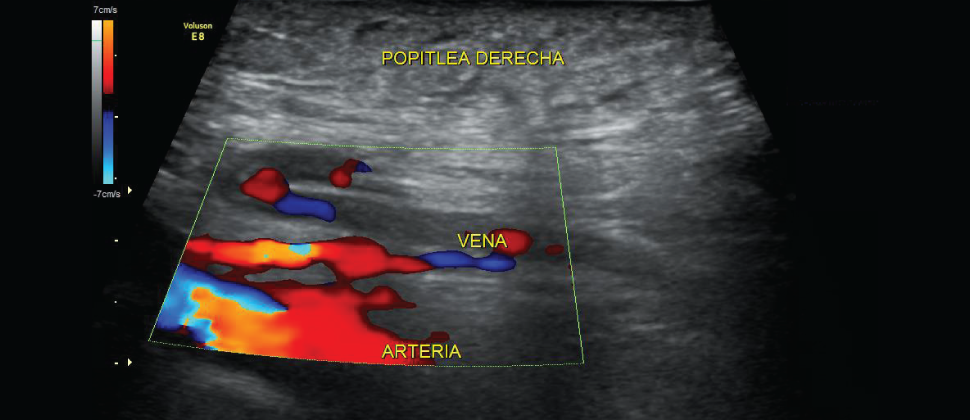 Ecografía Doppler Color