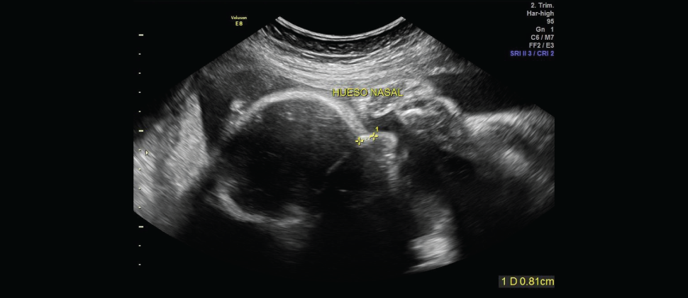 Ecografía Genética