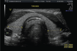 Biopsia de tiroides (BAAF)