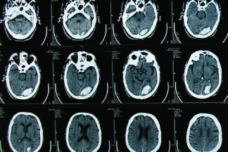 Tomografía computada