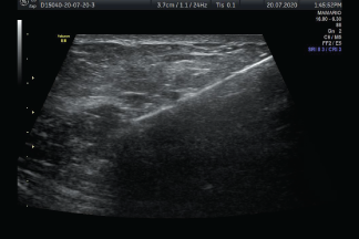 Biopsia guiada por ultrasonido