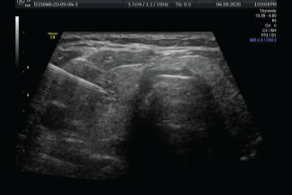 Biopsia guiada por ultrasonido
